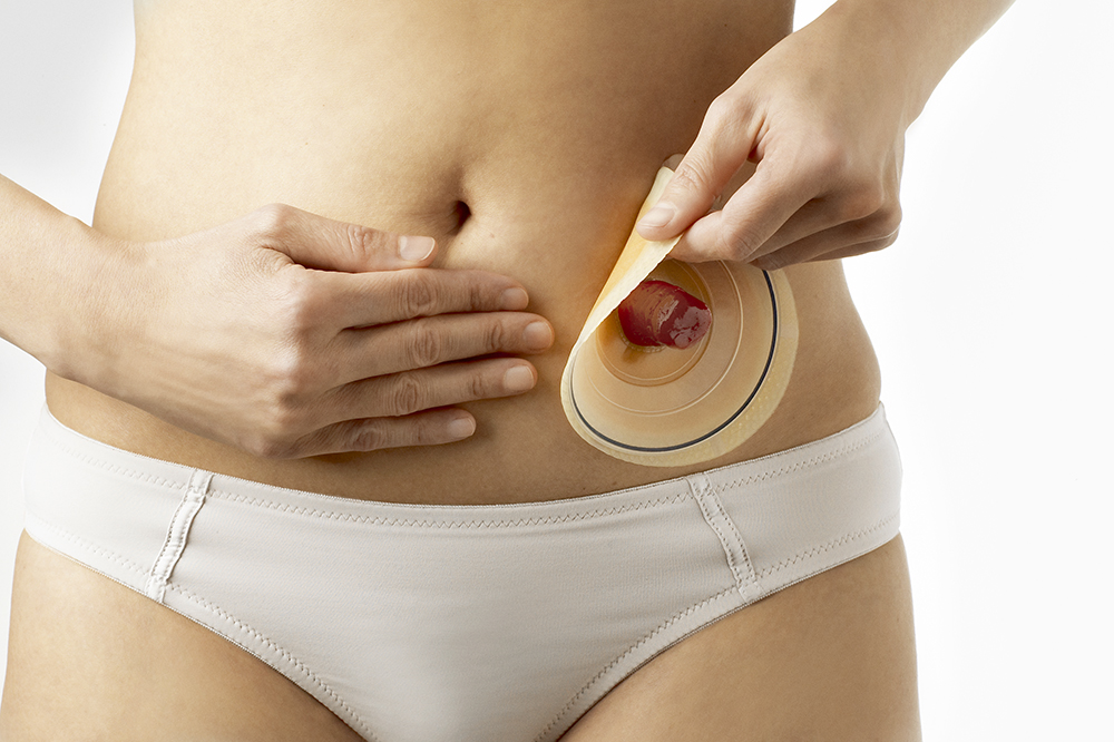 Cuidado de ostomía: cómo limpiar el estoma, cambiar la bolsa y prevenir complicaciones. Guía práctica para pacientes y personal de salud en Guatemala.